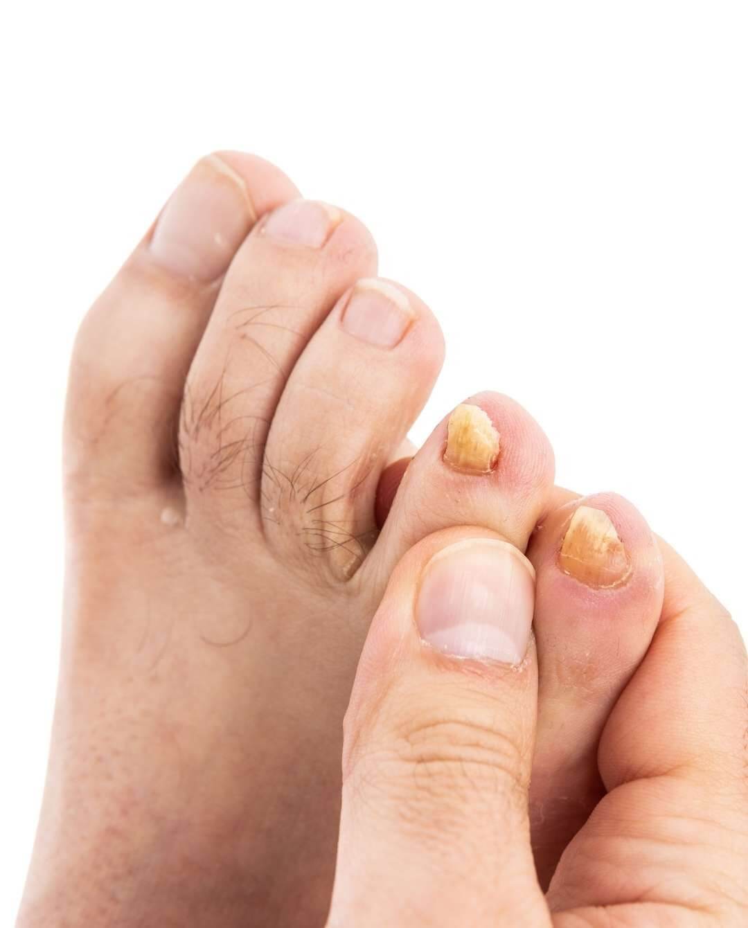 How is Urea used to treat fungal infections of the toe and finger nails? |  MyFootShop.com