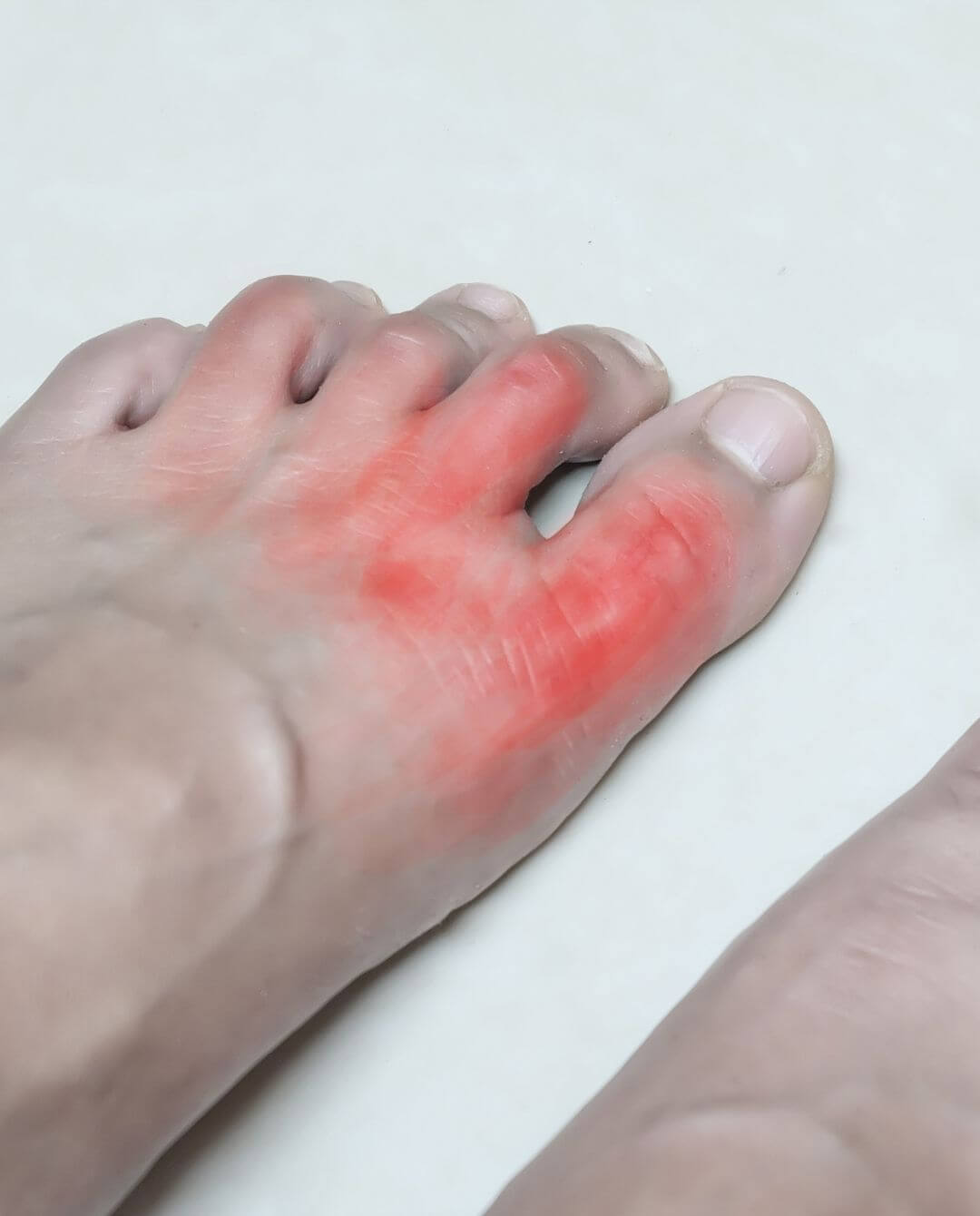 A foot showing gout symptoms in the toes