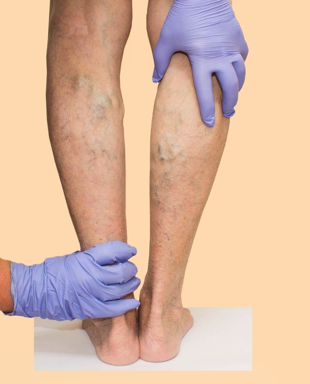 Varicose veins Two hands with purple gloves holding two legs showing varicose veins in the calves