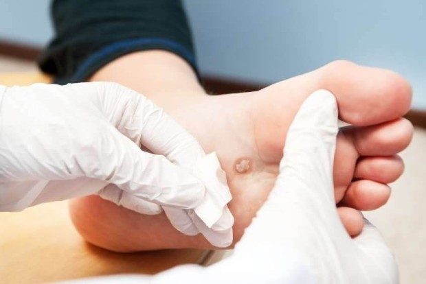 a white gloved hand holding a foot and pulling a bandage off a wart
