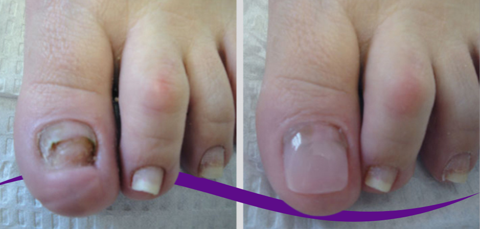 Normal Toenail Three Ways To Transform The Appearance Of Your Toenails (Podiatrist ...