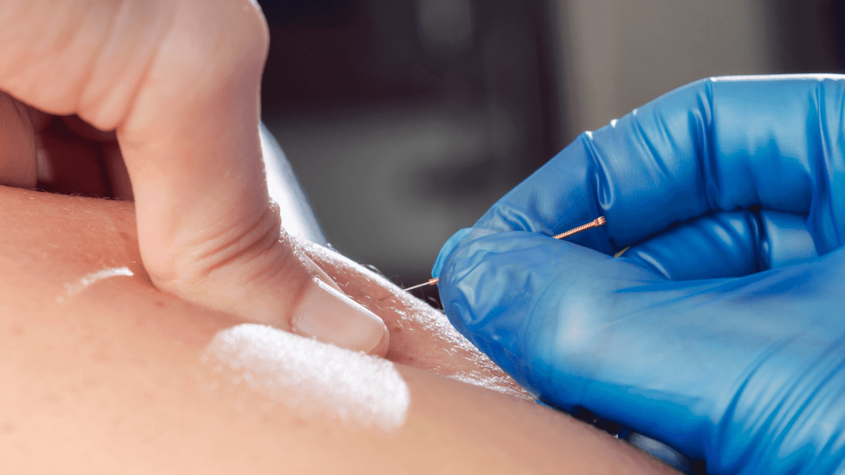 A close up of a blue goved hand placing a thin needle into the skin as part of a dry needling session
