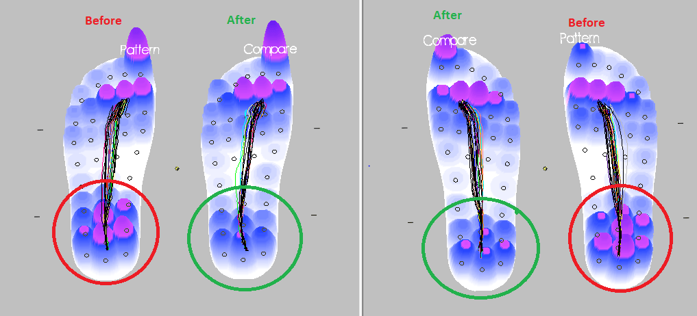 A comparison image showing two scans of feet using the Parotec pressure analysis system, one shows pressure in the feet before treatment compared to good pressure levels in the feet after treatment