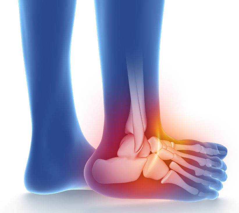 Ankle Ligament Injuries