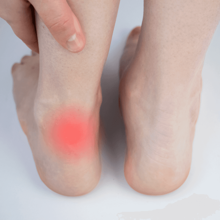 Retrocalcaneal Bursitis: Achilles Tendon Swelling & Heel Pain