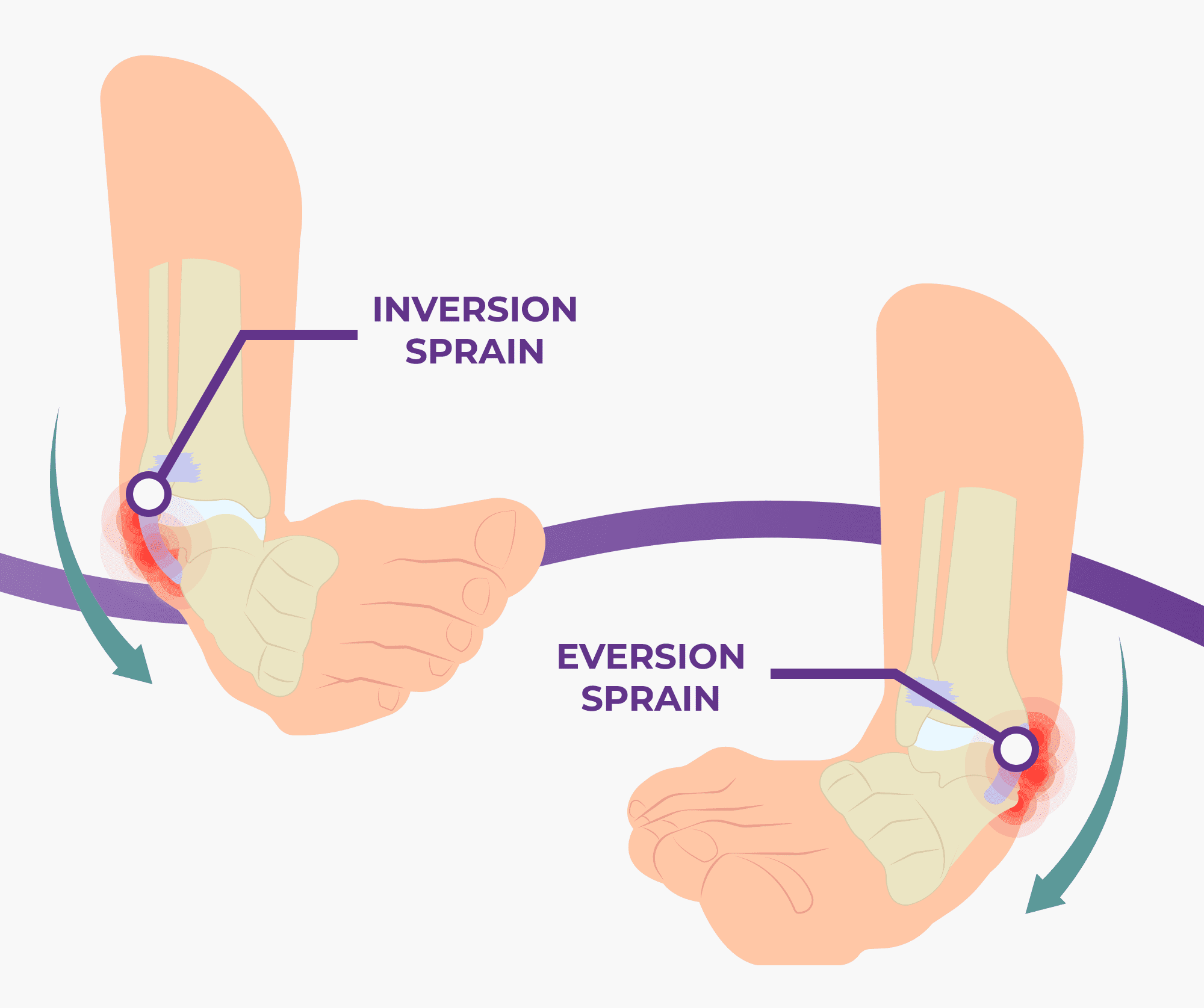 Sprained ankle cause and treatment with 2 exercises