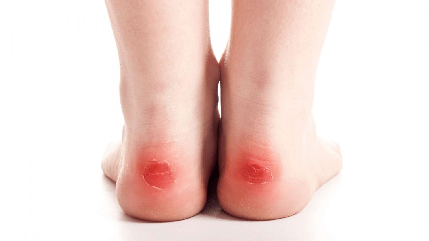 Blisters (Source: thefeetpeople.com.au)