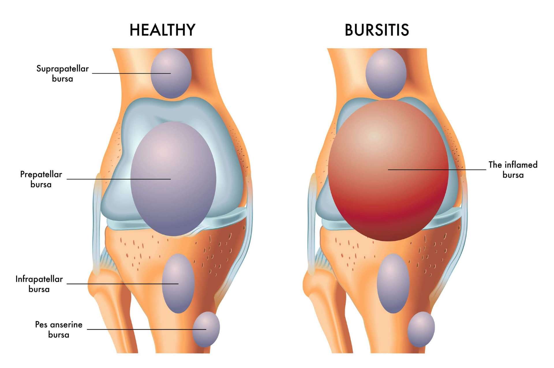 Healthy knee vs bursitis knee Diagram comparing a bursitis knee joint against a healthy knee joint