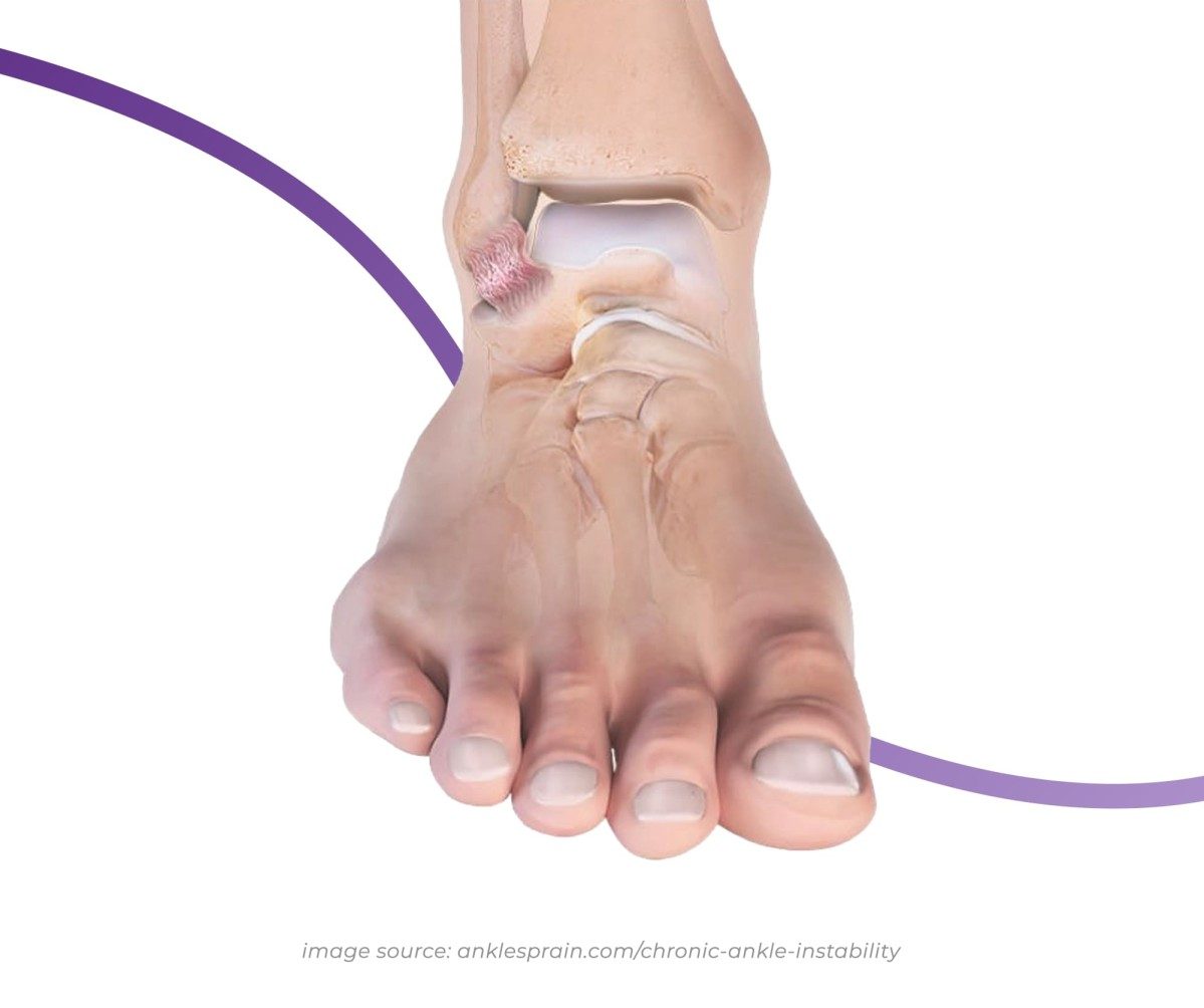 Chronic Ankle Instability Causes, Symptoms & Treatment
