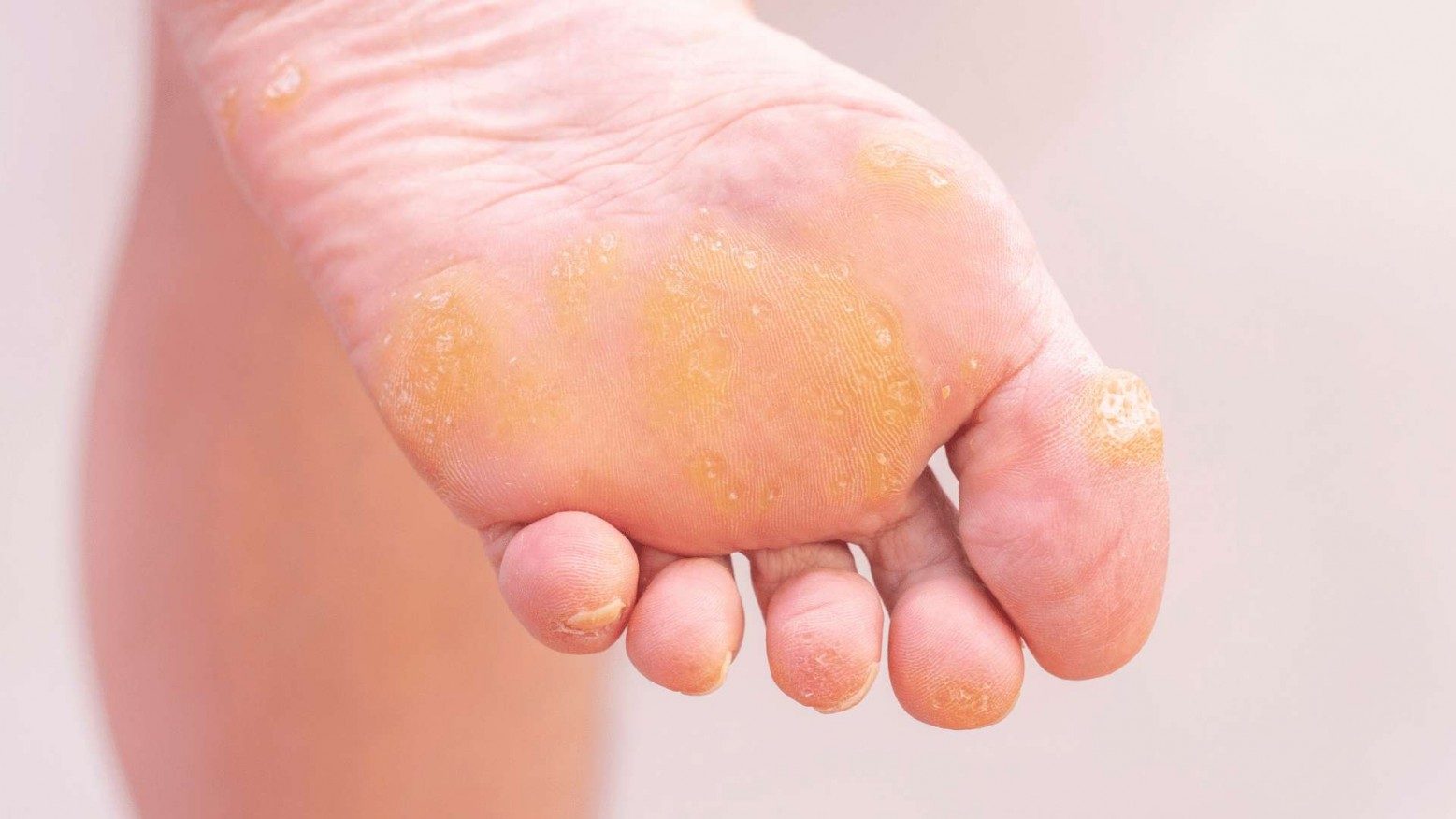 The bottom of a foot covered in calluses and corns.