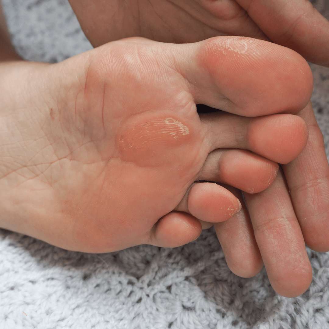 Fingers showing underneath a foot where a hard corn has formed