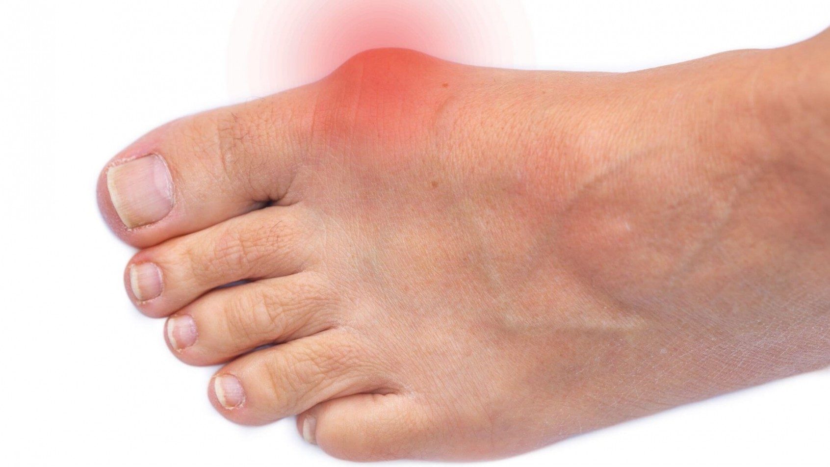 A top view of a foot with a bunion under the big toe, highlighted in red to signify pain