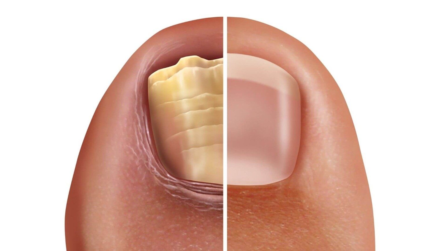 Top 5 Signs Your Toenail Fungus May Have Escalated to an Infection: Rocky  Mountain Foot & Ankle Center: Foot & Ankle Surgeons