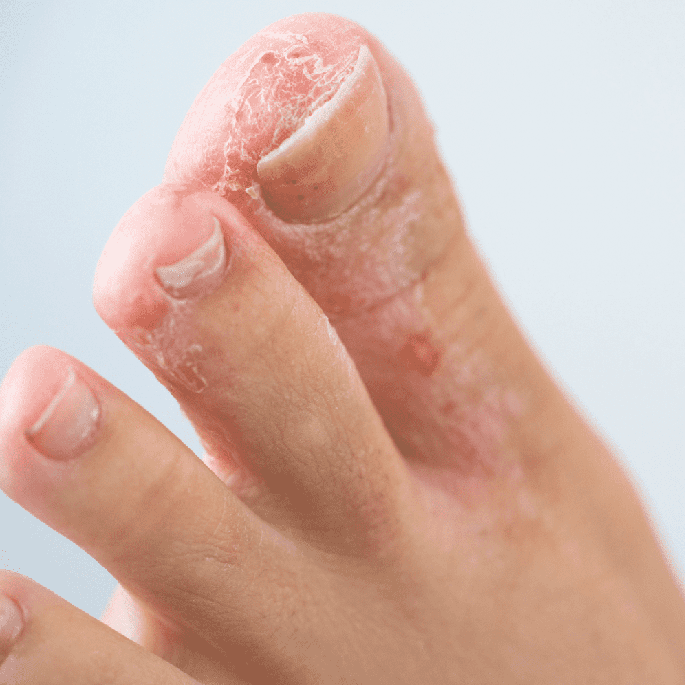 A close up of three toes with flaky skin signifying Athlete's Foot