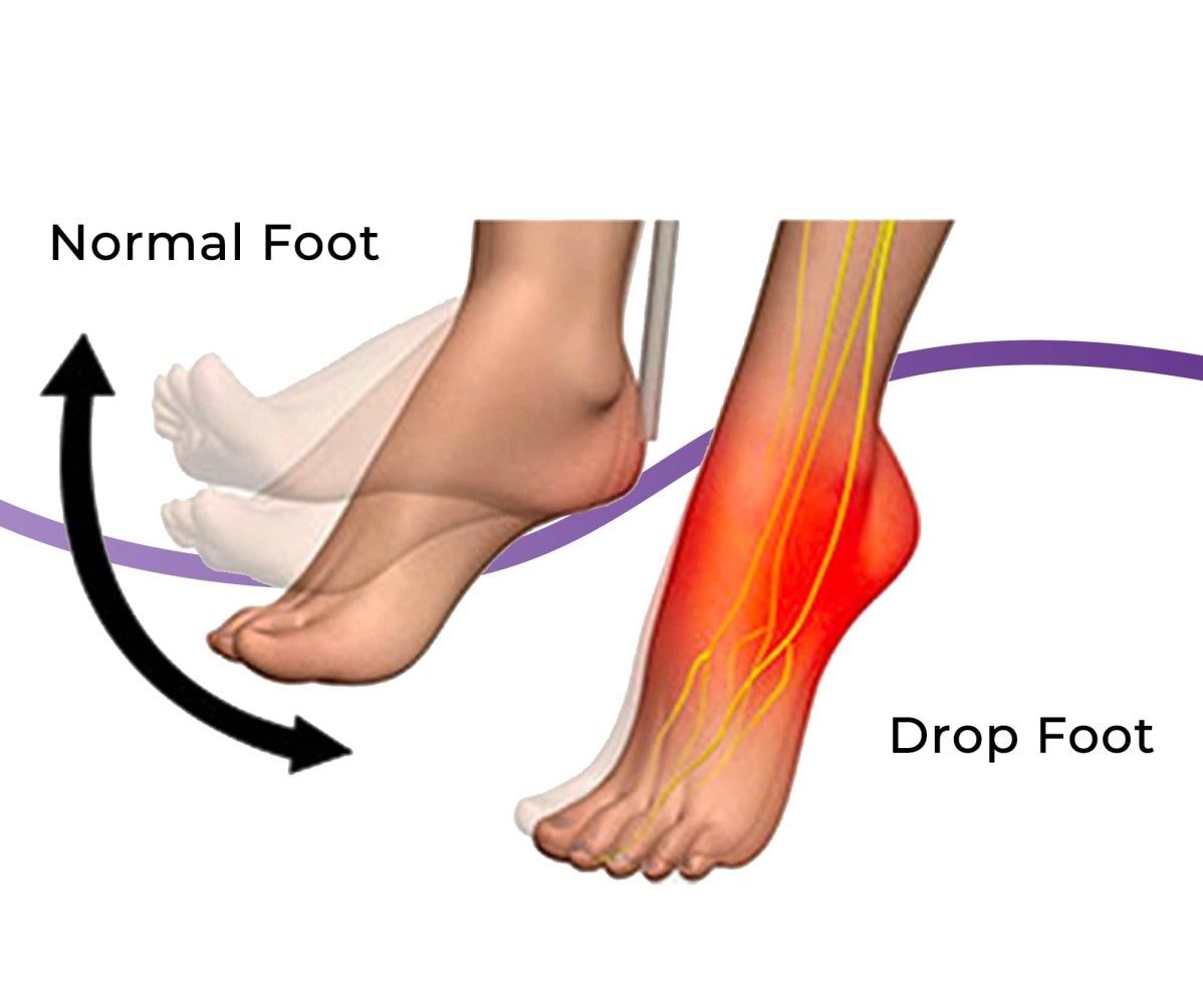 Foot Drop: Causes, Symptoms & Treatment