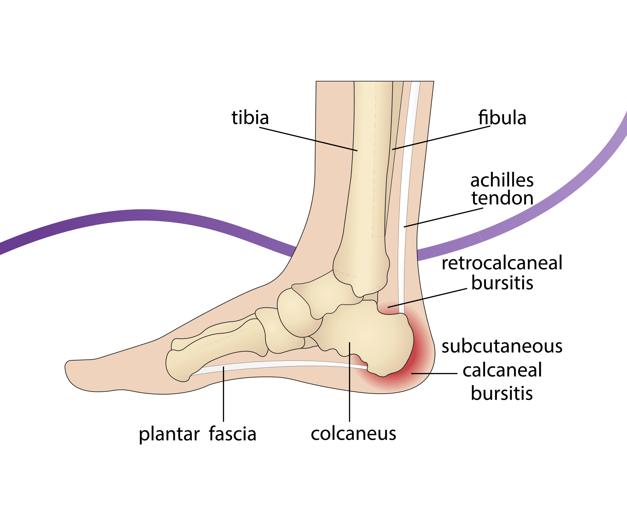 Haglund's Deformity Causes, Symptoms & Treatment The Feet People