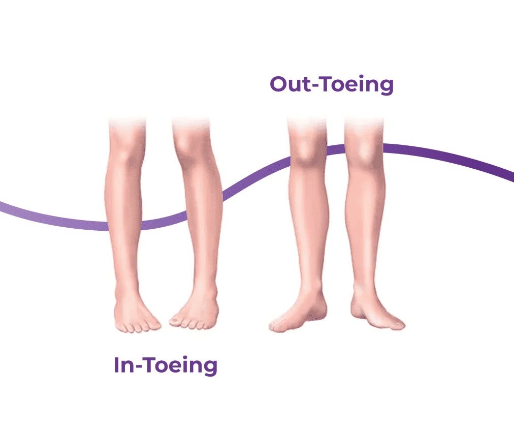 Back of two feet and ankles with a highlighted red area over the Achilles tendinopathy showing pain