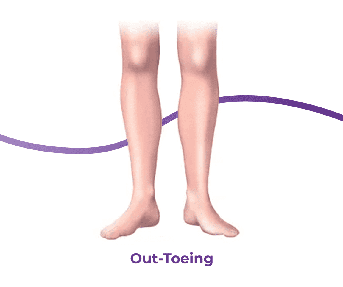 InToeing & OutToeing Causes, Symptoms & Treatment The Feet People