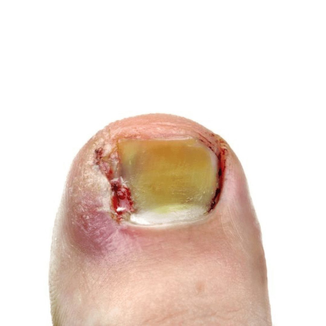 A big toe with a yellow nail and severe ingrown toenail