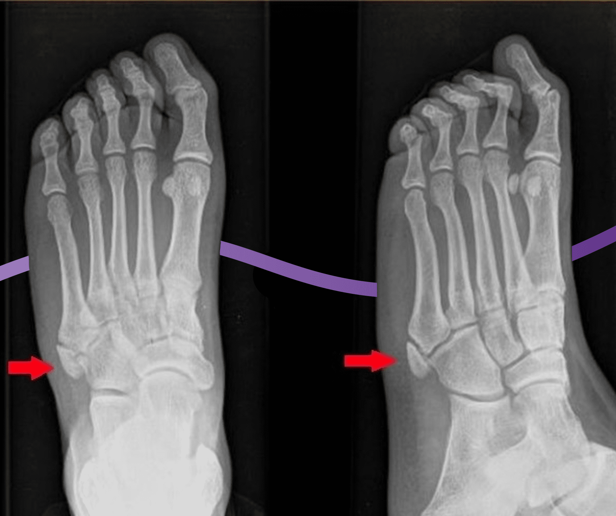 Heel Pain : Mnemonic | Epomedicine