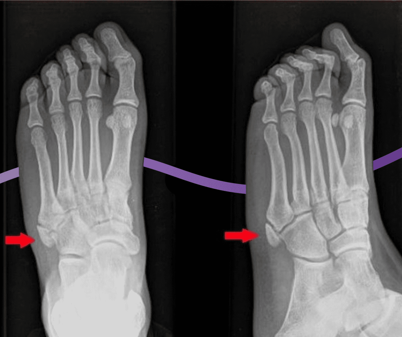 A side view of a foot with a hand holding the ankle. The ankle is highlighted red signifying pain