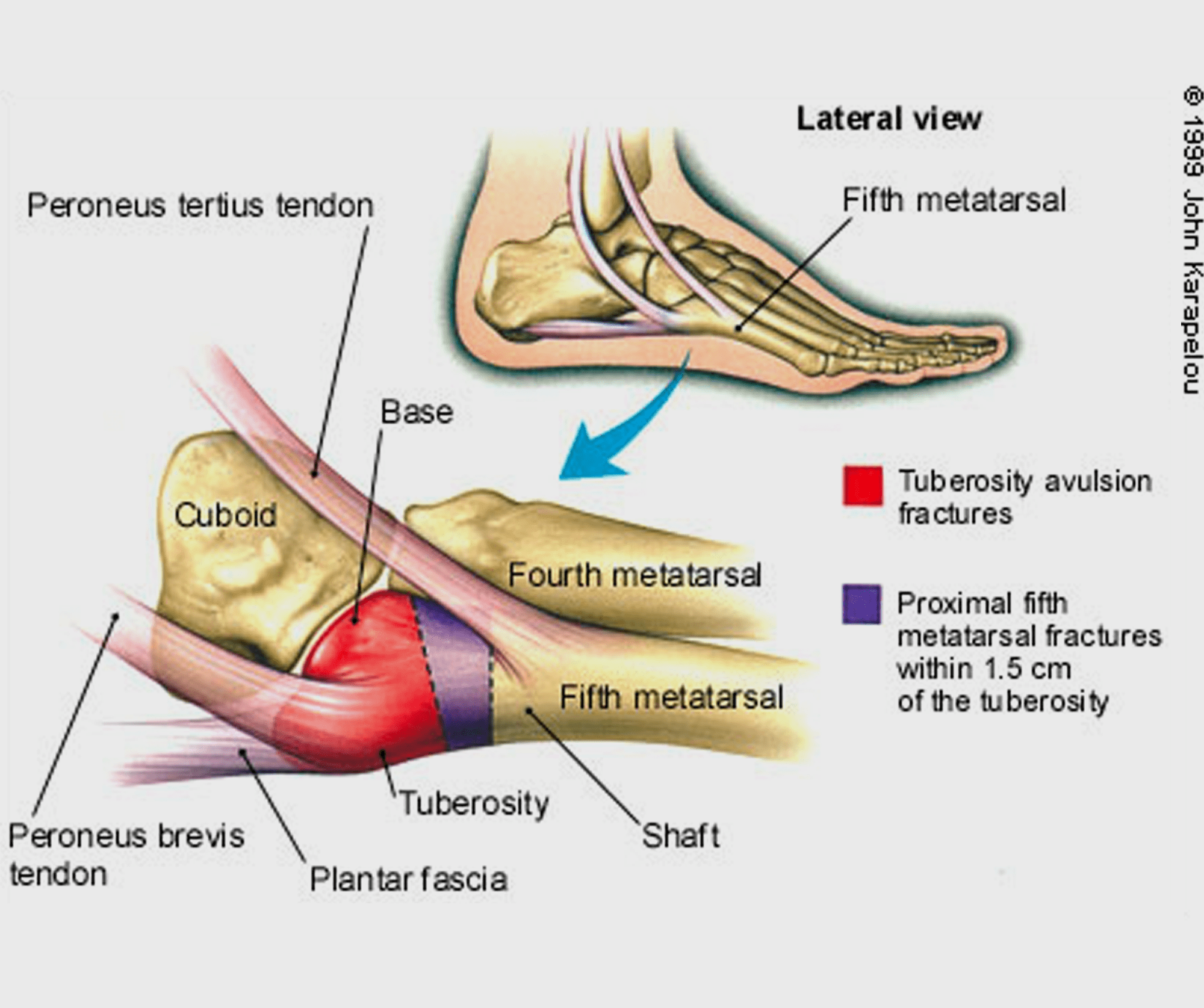 Ankle Fractures - Footcare Friday: Alpine Orthopedics and Sports Medicine:  Orthopedic Surgery