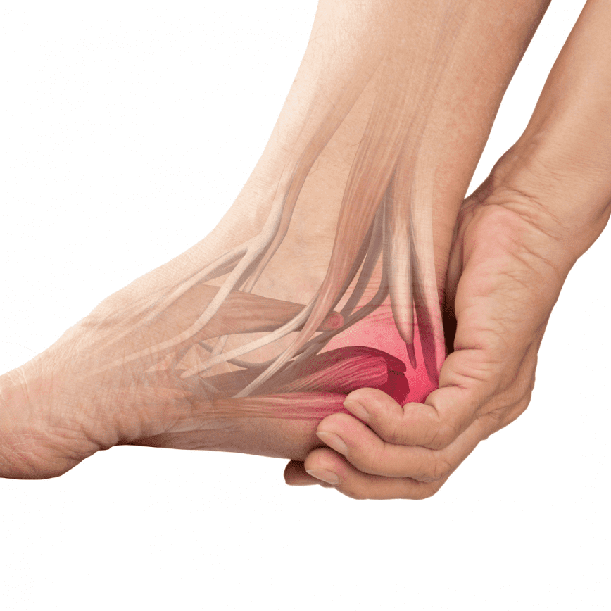 Plantar fasciitis - Symptoms and causes - Mayo Clinic