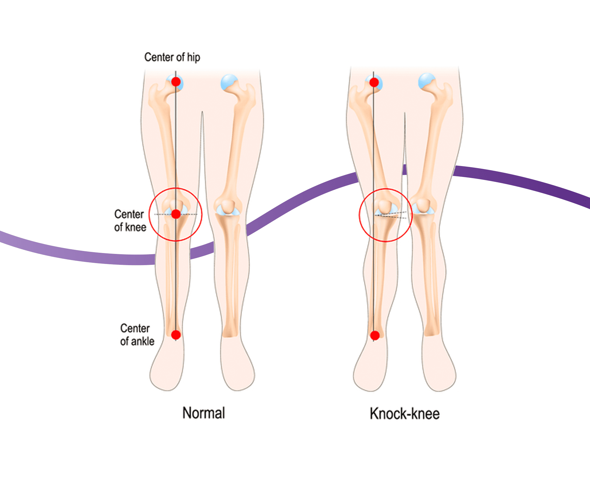 Knocked Knees (Genu Valgum) Causes, Symptoms & Treatment The Feet