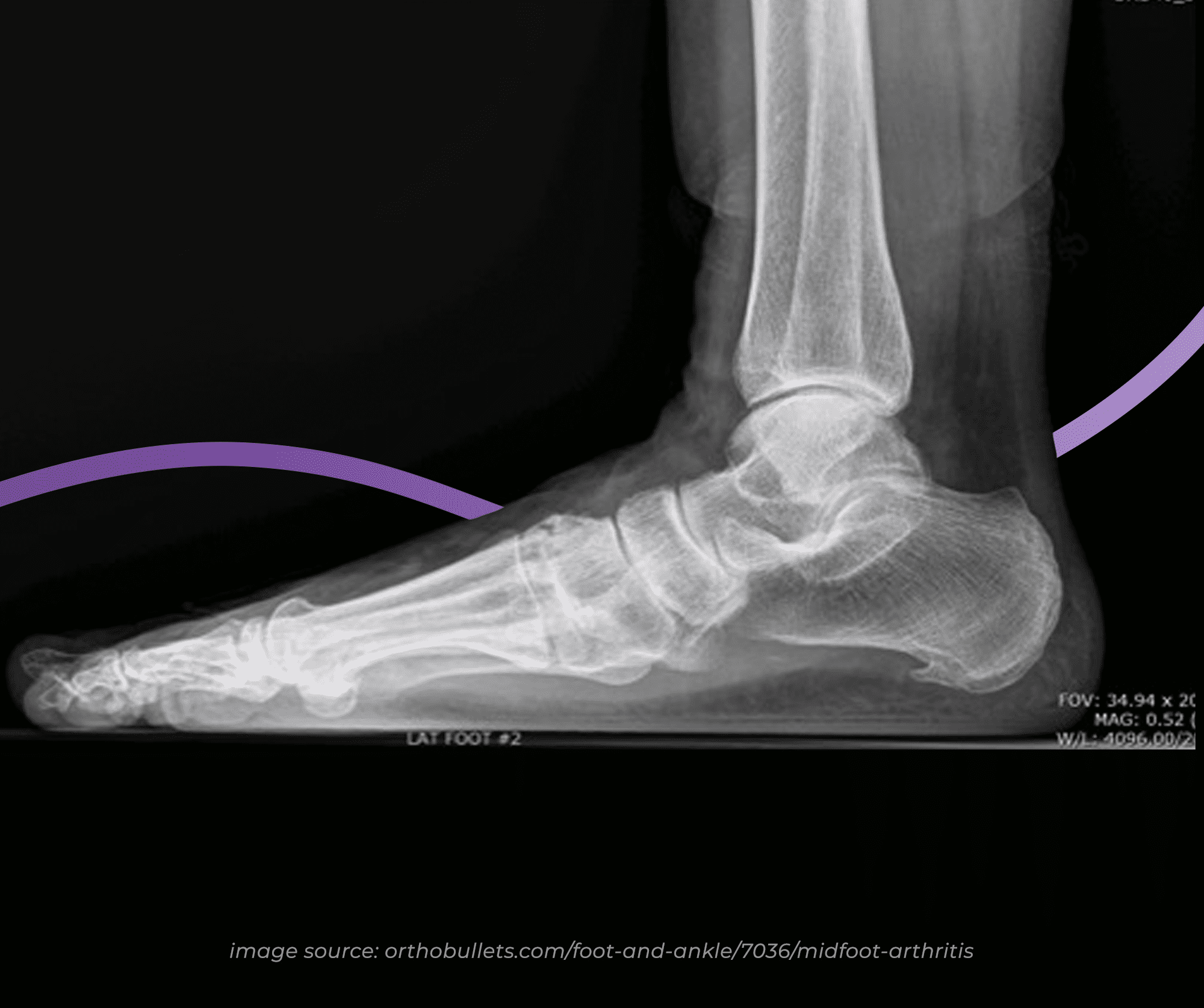 Mid Foot Osteoarthritis Causes, Symptoms & Treatment The Feet People