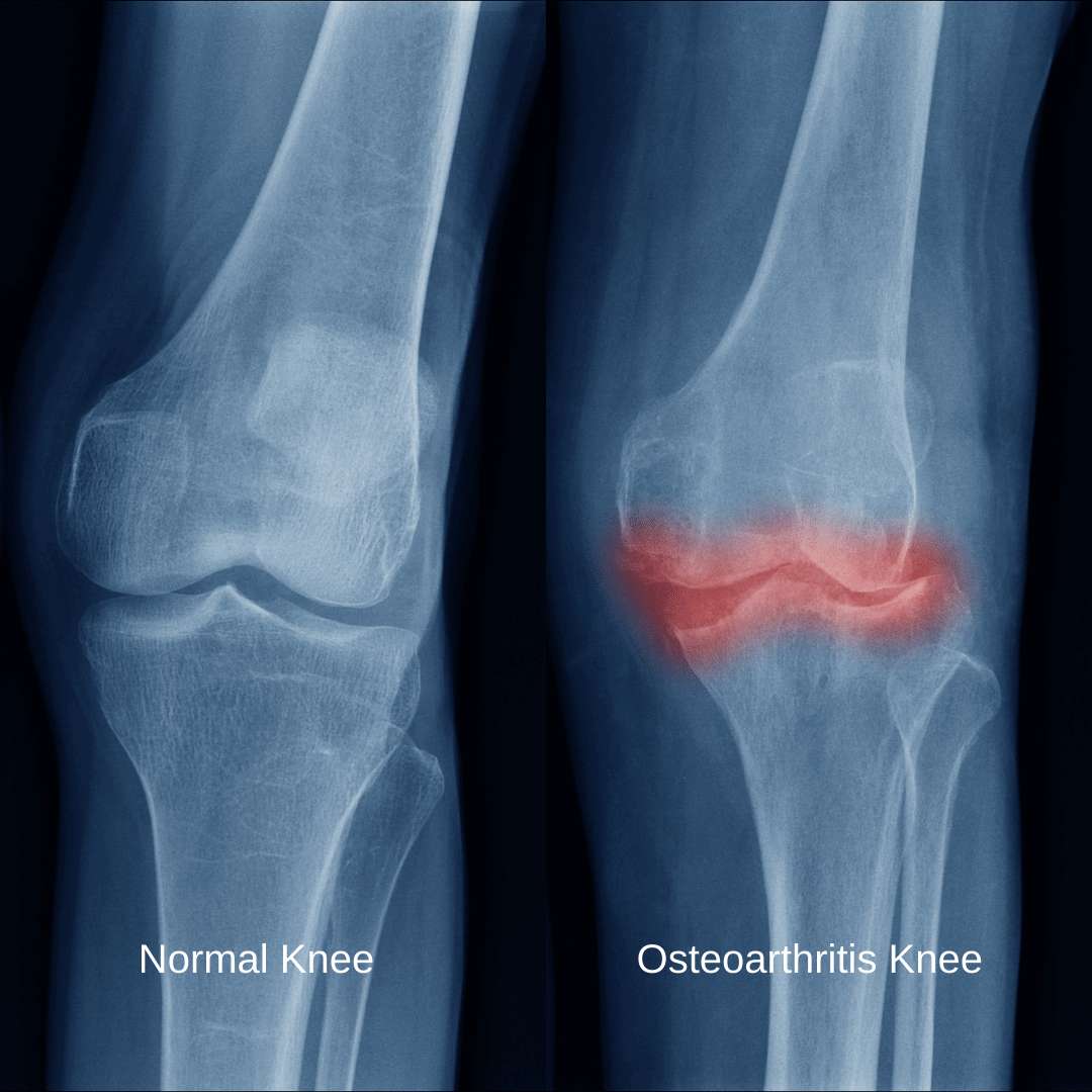 Two x-rays comparing a normal knee with an osteoarthritis knee