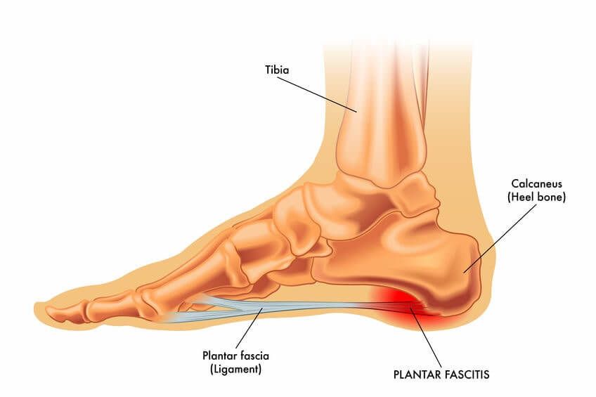 Diagram of a skeletal foot showing where plantar fasciitis occurs