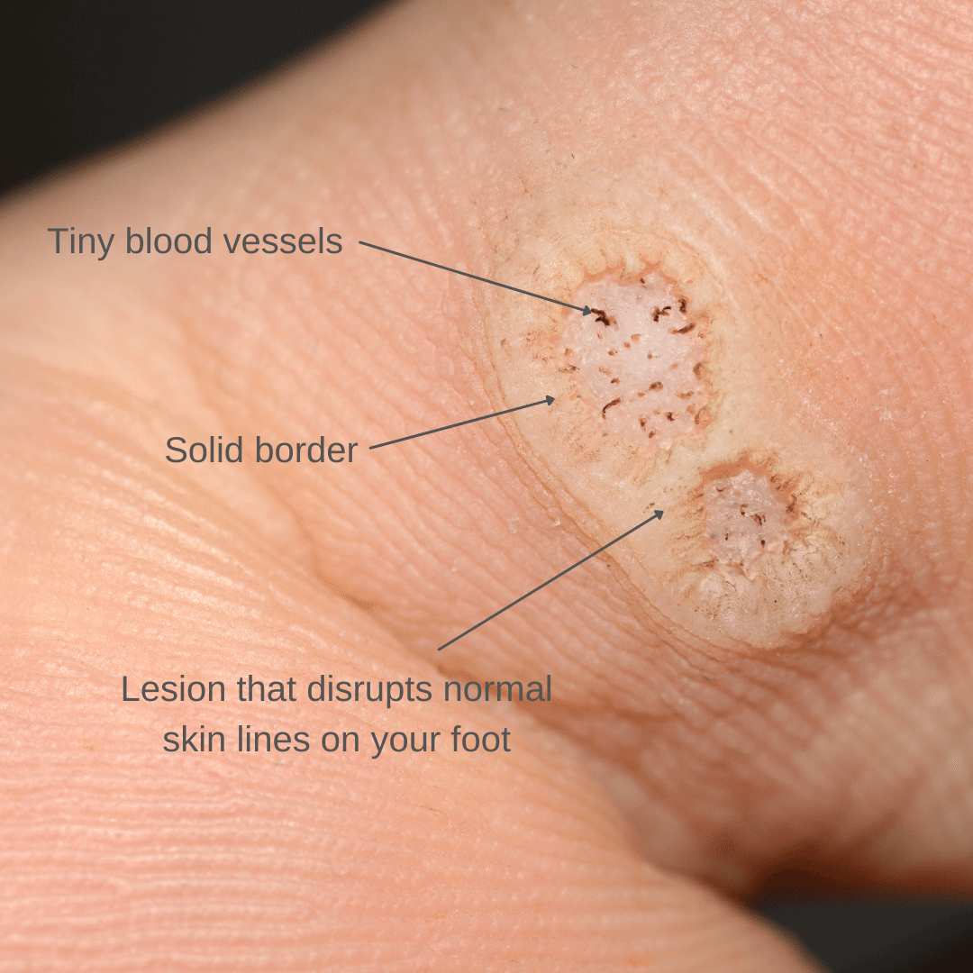 Plantar wart a hand peeling off a bandage showing the plantar wart on the bottom of their foot