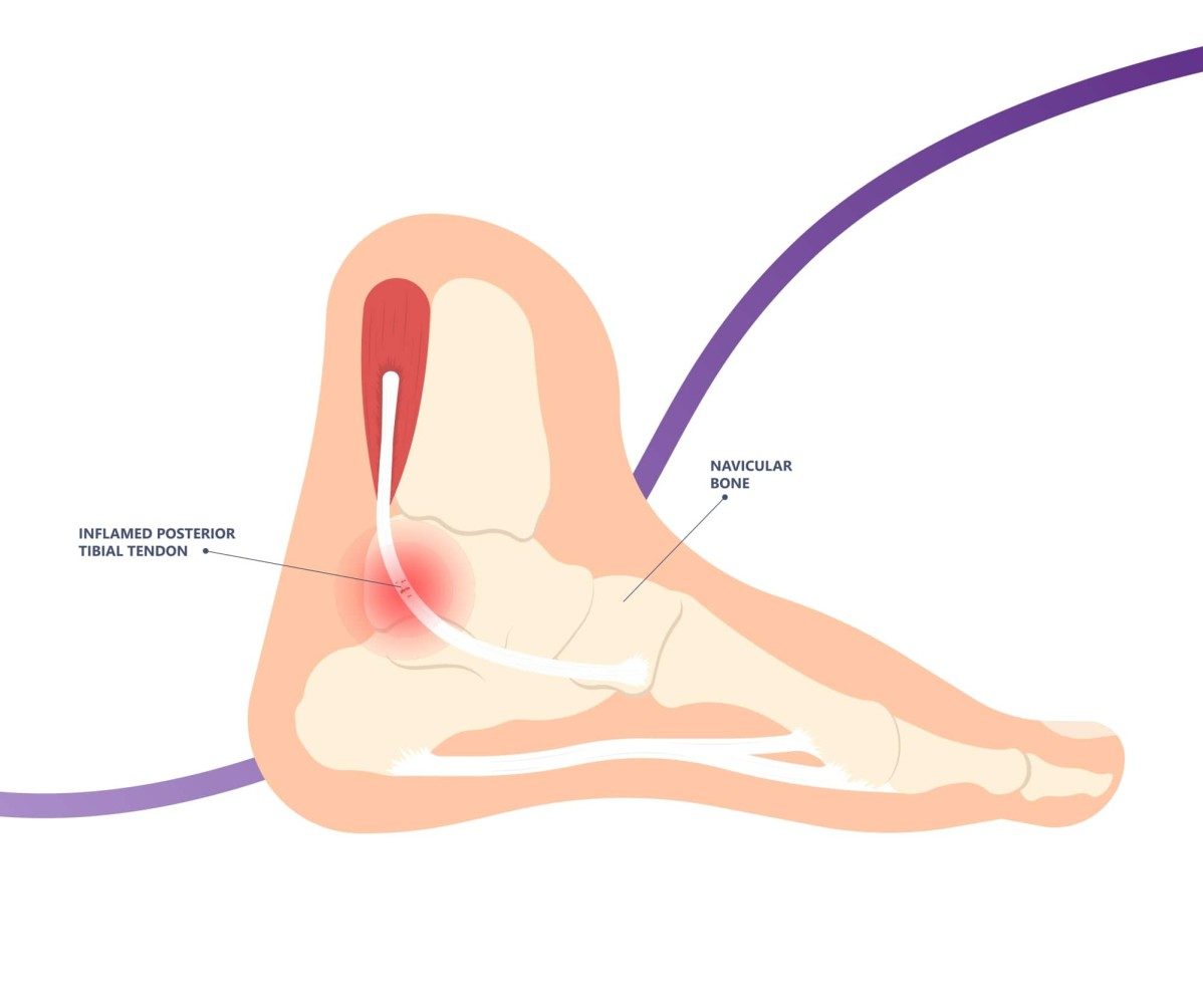 Posterior tibial tendon dysfunction