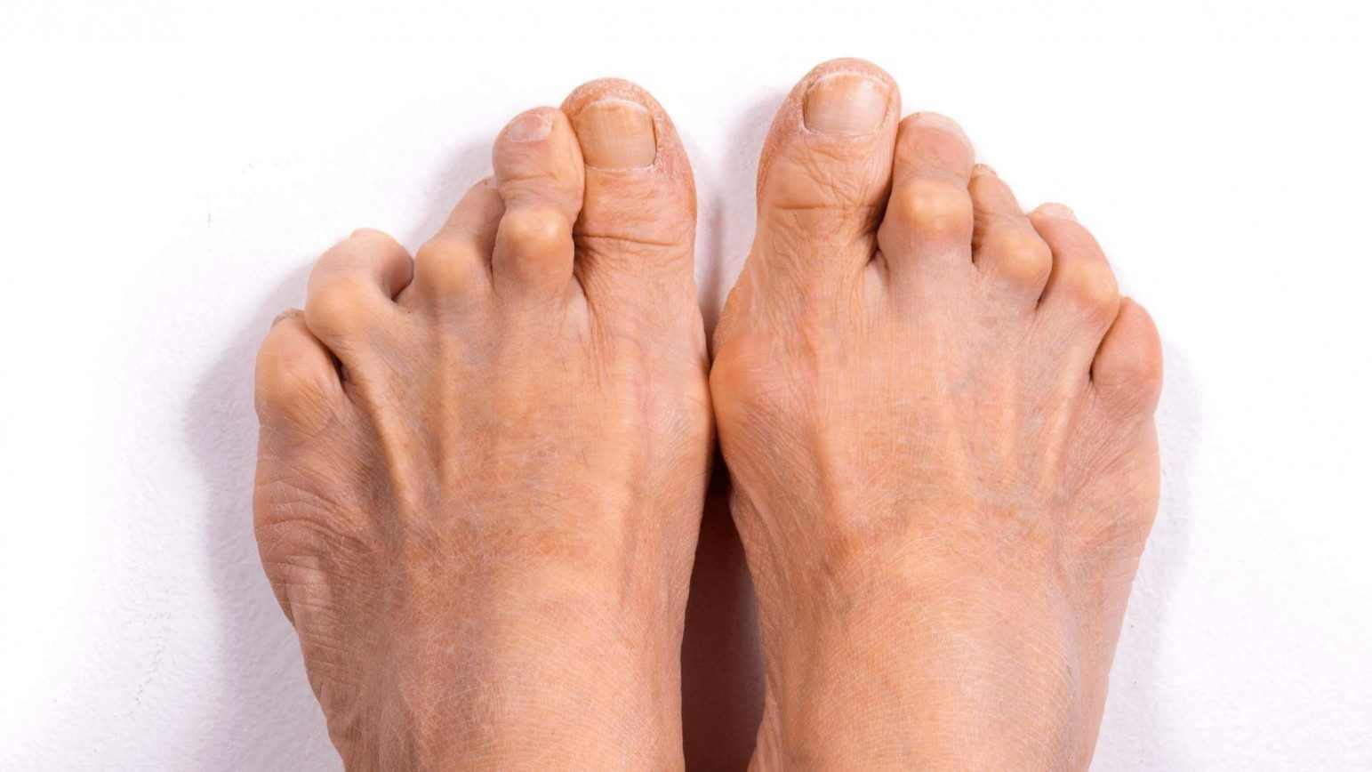 Top of two feet with bunched up toes showing the physical signs and symptoms of rheumatoid arthritis