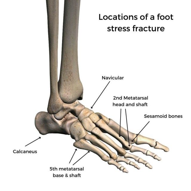 How do you treat a calcaneus stress fracture? - YouTube