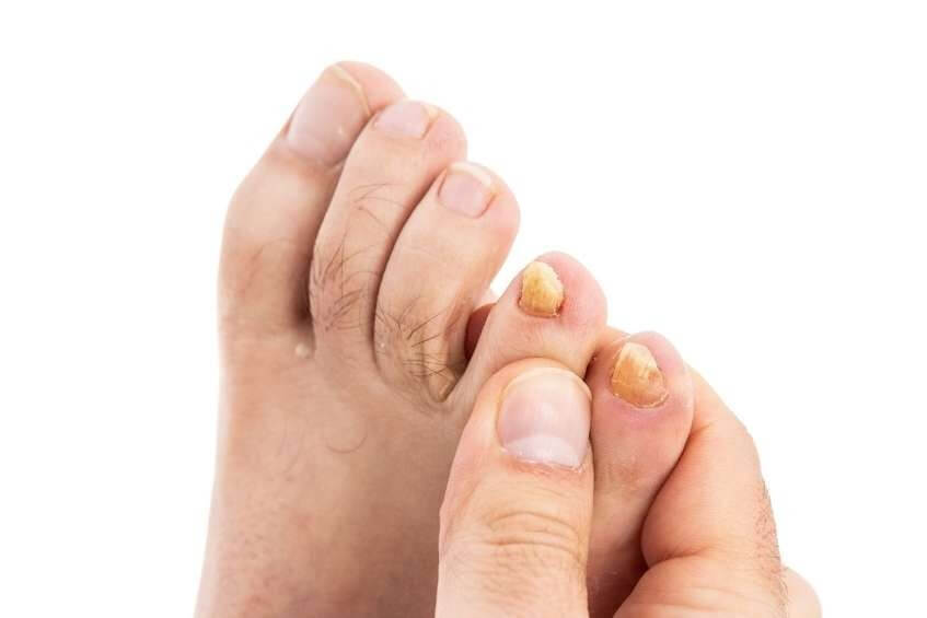 Fungal toe nails are a contagious... - Carlisle Podiatry | Facebook