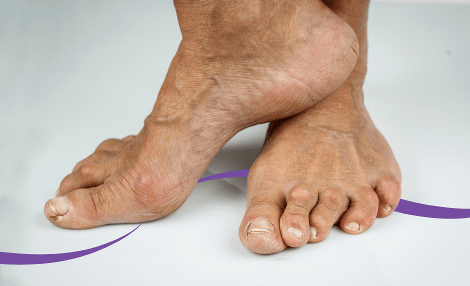 Arthritis And The Feet: Can You Stop The Pain?