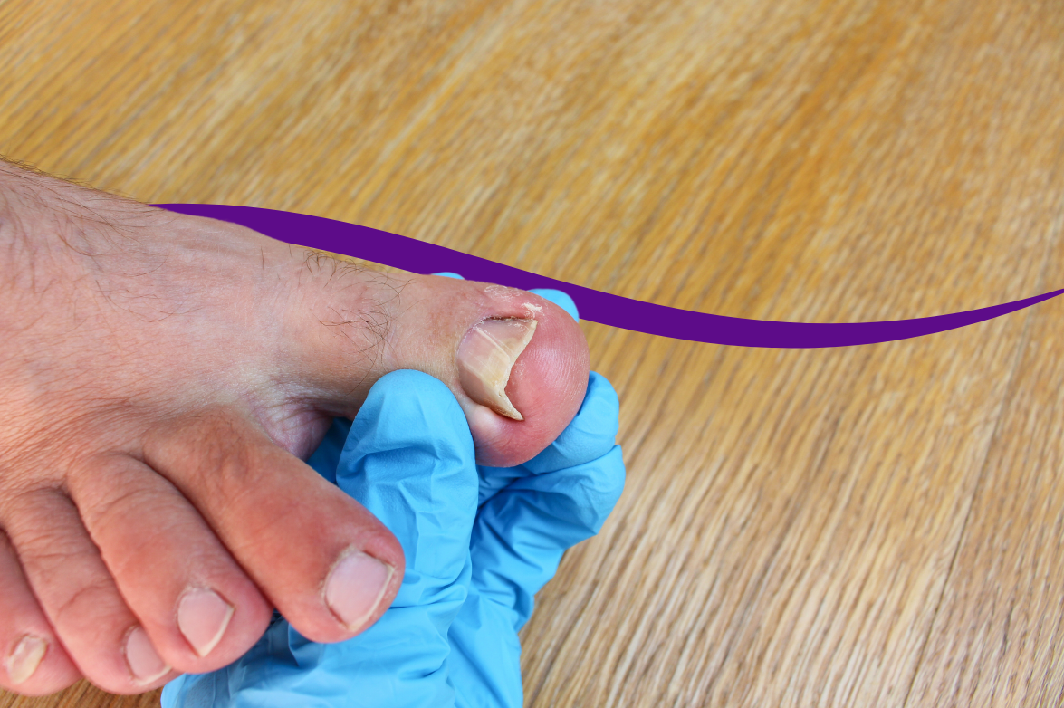 What causes fungal nail infection and how can you treat it? – Marlow Face  and Body