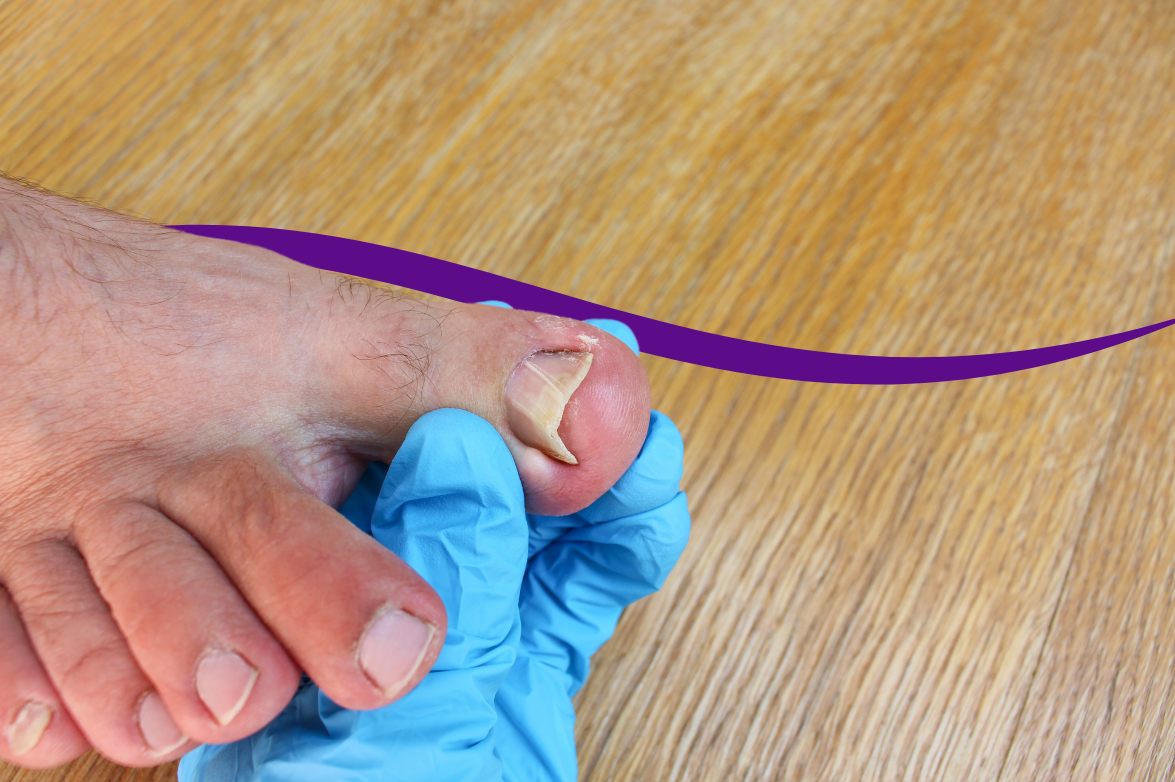 Why Antibiotics Won't Fix Your Ingrown Toenail